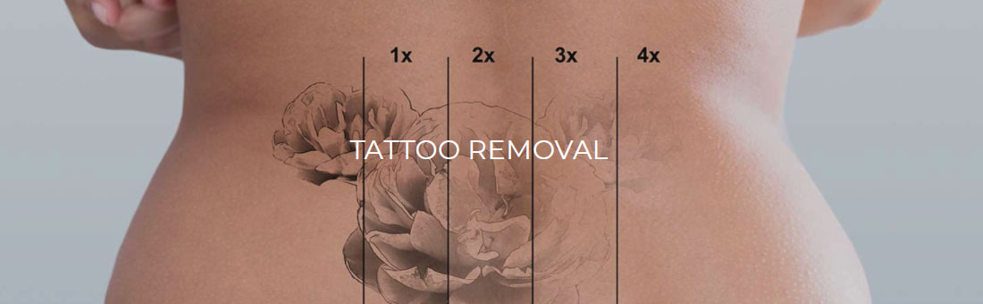 How To Speed Up Tattoo Removal And Fading  Fresh Skin Canvas