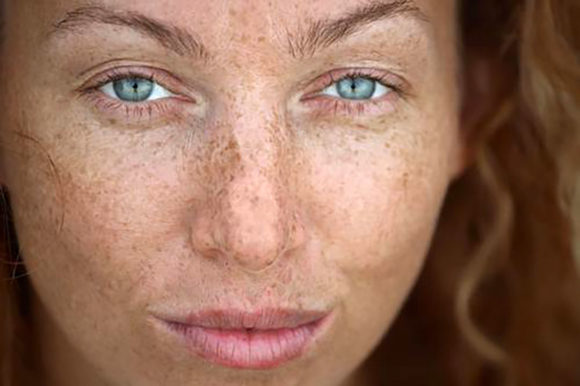 How IPL Works to Improve the Appearance of Your Skin